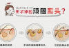 黑头贴的正确使用频率与皮肤护理指南