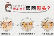 黑头贴的正确使用频率与皮肤护理指南