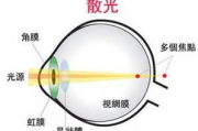 蝴蝶斑去除方法及预防策略解析