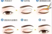 割双眼皮的类型及其特点-整形美容解决方案解析
