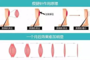 溶脂针瘦身,非手术美容新选择-效果与操作解析