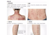 红痣与血痣图片对比及特征分析