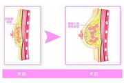 自体脂肪隆胸与瘦身：效果与误区解析