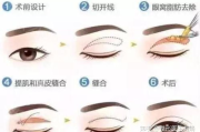 双眼皮手术案例图片,流行趋势与术后护理指南