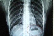 胸透照片的重要性与应用解析-医学诊断中的关键角色