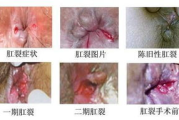 新冠咳嗽持续时间解析-常见症状与恢复时间