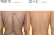 瘦身吸脂对身体有害吗-手术风险与效果分析