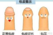 男士龟头边缘白色物质解析-常见原因与处理方法