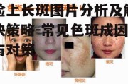 脸上长斑图片分析及解决策略-常见色斑成因与对策