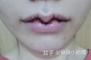 厚唇改薄术后后悔,如何应对与改善建议