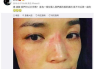 过敏脸图片识别与预防策略-皮肤过敏症状解读