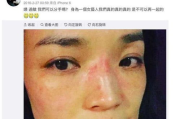 过敏脸图片识别与预防策略-皮肤过敏症状解读