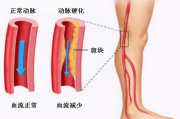 下肢腿部抬高垫,S腿垫翻身垫-全方位护理解决方案解析