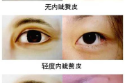 开后眼角手术前后照片对比-美容整形效果解析