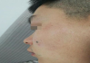 激光点痣掉痂后正常图样及恢复指南-美容术后护理解析