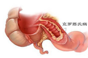 判断自己是否患有克罗恩病-症状与诊断方法解析