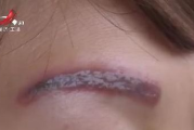 激光洗眉红印消退时间及护理方法解析
