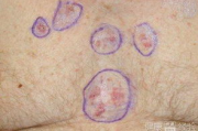 皮肤癌早期症状图片识别与预防措施