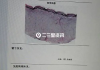 疤痕修复术价格揭秘-影响价格的因素与选择指南