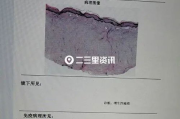 疤痕修复术价格揭秘-影响价格的因素与选择指南