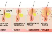 去除痘痘怎么有效果,科学护肤与专业治疗指南