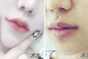 厚唇改薄术后再次变厚的原因分析与应对策略