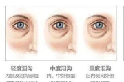 眼袋消除手法视频教程-轻松告别眼部浮肿