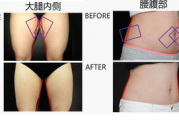 抽脂瘦身手术方法,美容塑形新选择-详细解析与优势对比