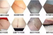 疤痕贴品牌选择指南-疤痕修复产品推荐