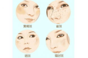 淡斑技巧大揭秘-有效淡斑方法一览
