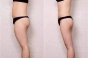 吸脂减肥瘦身术,现代塑形解决方案解析