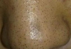 黑头导出液原理与使用方法解析-护肤清洁解决方案