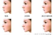 玻尿酸隆鼻一年后鼻梁变宽原因分析与解决策略
