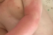 激光美白潜在副作用及应对措施-美容安全指南
