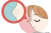 最简单最有效的去黑头,家庭护肤解决方案解析
