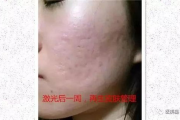 激光祛痘印效果图展示与效果分析-美容技术解析