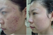 脸上突然长了好多疙瘩,原因分析与解决策略