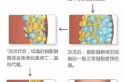 注射溶脂瘦身,非手术减肥新选择-效果与风险分析