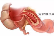 克罗恩病诊断方法与症状分析-专业医学解析