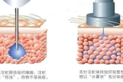 钒钛无针水光技术解析与美容效果探究