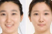 抽脂瘦身美容医院选择指南-专业与安全并重