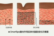 激光溶脂瘦身,现代塑形技术的革新-全面解析