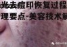 激光去痘印恢复过程及护理要点-美容技术解析