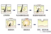 痘坑修复水,肌肤平滑的秘密武器-使用方法与效果分析