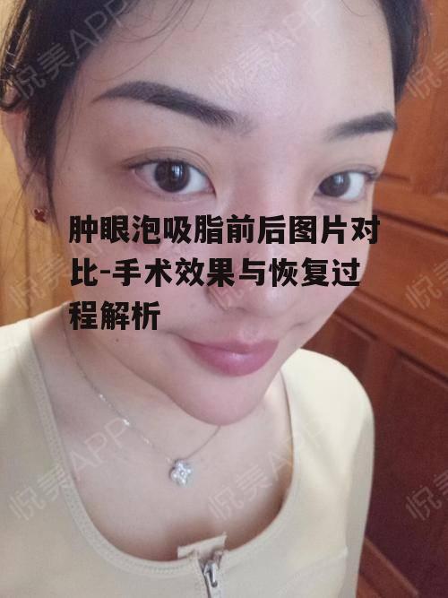 一、肿眼泡吸脂手术简介
