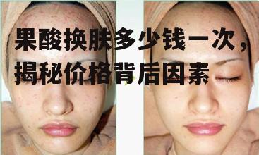 一、果酸换肤的原理及效果